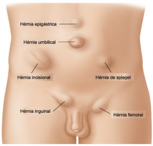 Hérnias da parede abdominal 