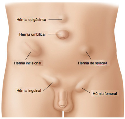 Mulheres com hérnia na virilha precisam de cirurgia de urgência em