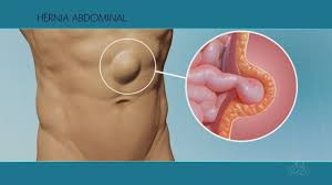 Hernia (abdominal)