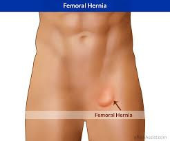 Hérnia femoral