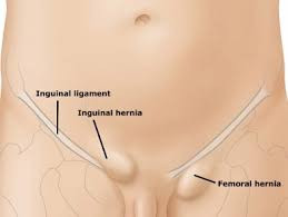 Fiz cirurgia de hérnia inguinal e umbilical quanto tempo depois eu