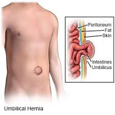 HERNIA ABDOMINAL - DR PABLO HÜBNER - CIRURGIAS