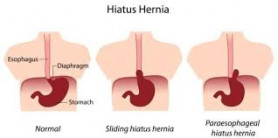 Hiatus Hernia