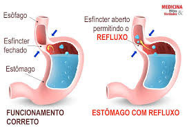 REFLUXO GASTROESOFÁGICO